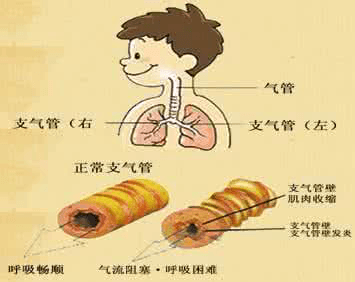 不打针不吃药，负氧离子治疗气管炎好转率达95%