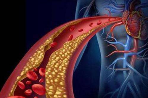 临床证实：负氧离子治疗高血脂症是一种安全、有效的手段